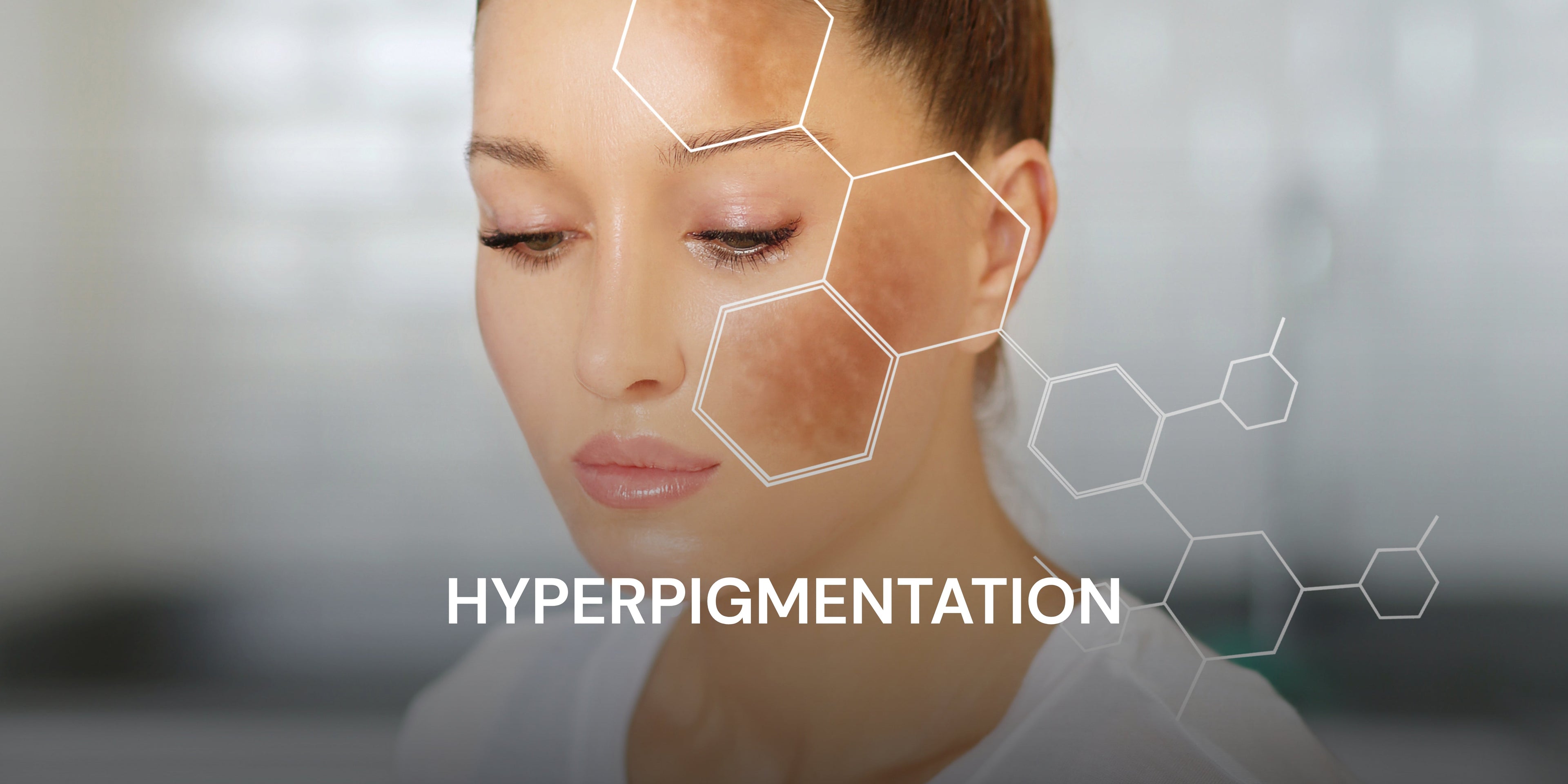 HYPERPIGMENTATION